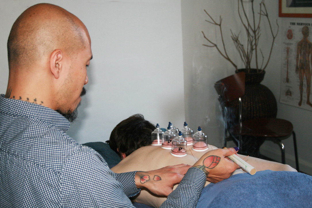 Acupuncture treatment being delivered at Uprise Health